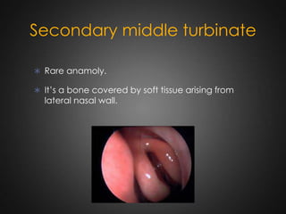 Secondary middle turbinate
 Rare anamoly.
 It’s a bone covered by soft tissue arising from

lateral nasal wall.

 