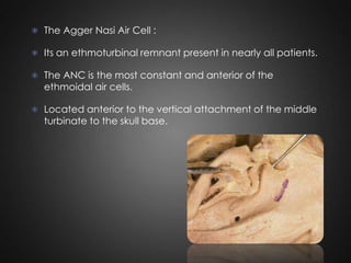  The Agger Nasi Air Cell :
 Its an ethmoturbinal remnant present in nearly all patients.
 The ANC is the most constant and anterior of the

ethmoidal air cells.

 Located anterior to the vertical attachment of the middle

turbinate to the skull base.

 