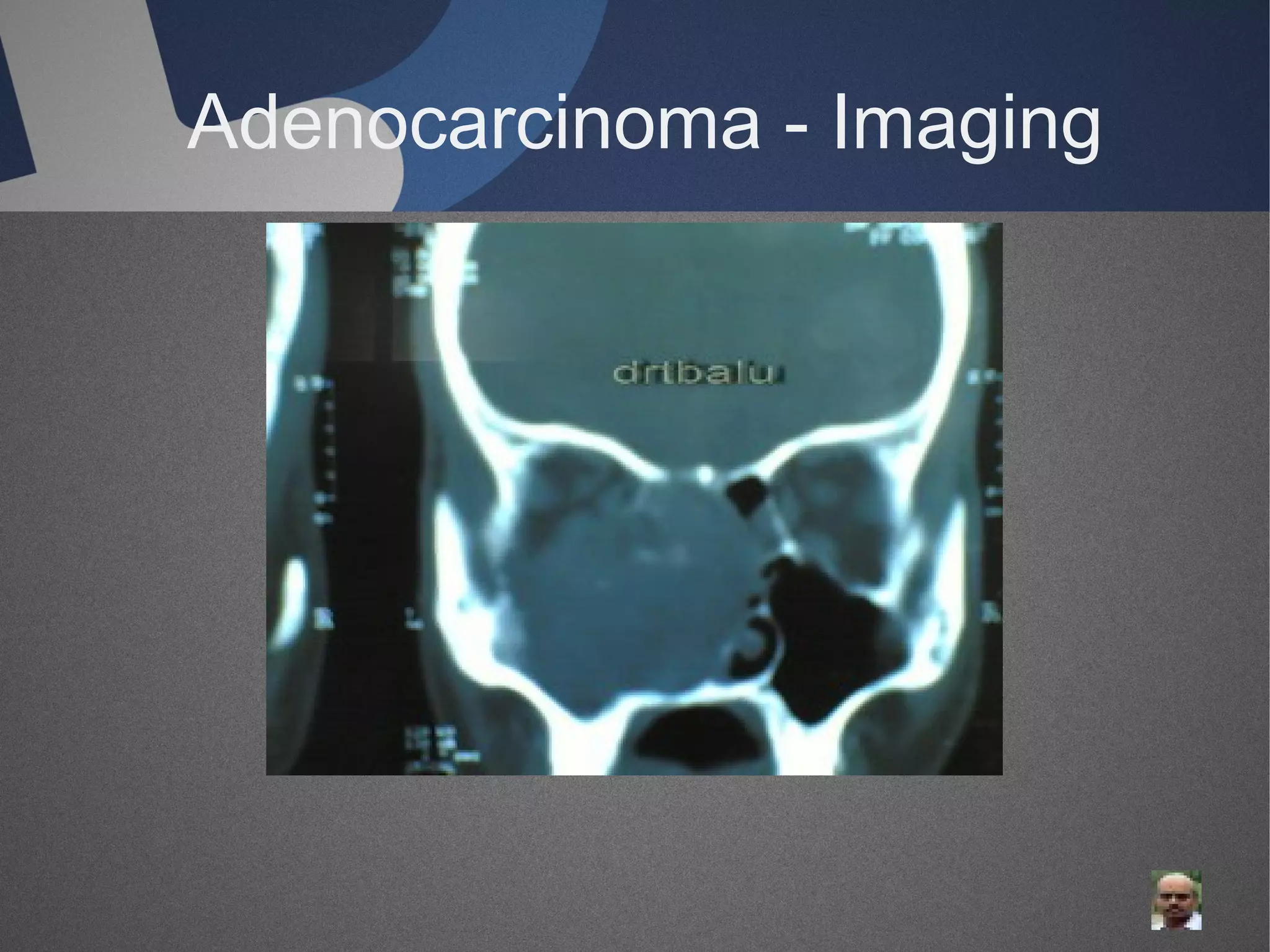 Adenocarcinoma - Imaging

 