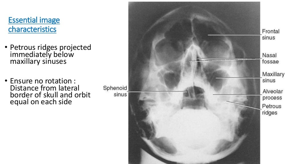 Anatomy and Xray of PNS and orbit