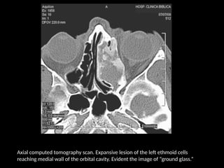 Axial computed tomography scan. Expansive lesion of the left ethmoid cells
reaching medial wall of the orbital cavity. Evident the image of “ground glass.”
 