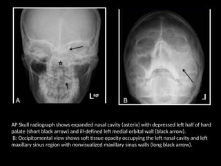 AP Skull radiograph shows expanded nasal cavity (asterix) with depressed left half of hard
palate (short black arrow) and ill-defined left medial orbital wall (black arrow).
B: Occipitomental view shows soft tissue opacity occupying the left nasal cavity and left
maxillary sinus region with nonvisualized maxillary sinus walls (long black arrow).
 