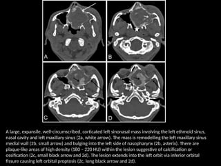 A large, expansile, well-circumscribed, corticated left sinonasal mass involving the left ethmoid sinus,
nasal cavity and left maxillary sinus (2a, white arrow). The mass is remodelling the left maxillary sinus
medial wall (2b, small arrow) and bulging into the left side of nasopharynx (2b, asterix). There are
plaque-like areas of high density (180 – 220 HU) within the lesion suggestive of calcification or
ossification (2c, small black arrow and 2d). The lesion extends into the left orbit via inferior orbital
fissure causing left orbital proptosis (2c, long black arrow and 2d).
 