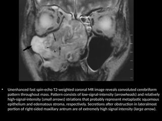 • Unenhanced fast spin-echo T2-weighted coronal MR image reveals convoluted cerebriform
pattern throughout mass. Pattern consists of low-signal-intensity (arrowheads) and relatively
high-signal-intensity (small arrows) striations that probably represent metaplastic squamous
epithelium and edematous stroma, respectively. Secretions after obstruction in lateralmost
portion of right-sided maxillary antrum are of extremely high signal intensity (large arrow).
 