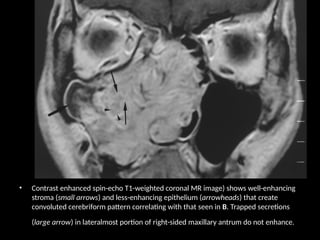 • Contrast enhanced spin-echo T1-weighted coronal MR image) shows well-enhancing
stroma (small arrows) and less-enhancing epithelium (arrowheads) that create
convoluted cerebriform pattern correlating with that seen in B. Trapped secretions
(large arrow) in lateralmost portion of right-sided maxillary antrum do not enhance.
 