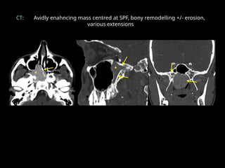 CT: Avidly enahncing mass centred at SPF, bony remodelling +/- erosion,
various extensions
• q
 