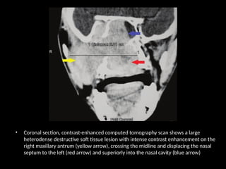 • Coronal section, contrast-enhanced computed tomography scan shows a large
heterodense destructive soft tissue lesion with intense contrast enhancement on the
right maxillary antrum (yellow arrow), crossing the midline and displacing the nasal
septum to the left (red arrow) and superiorly into the nasal cavity (blue arrow)
 