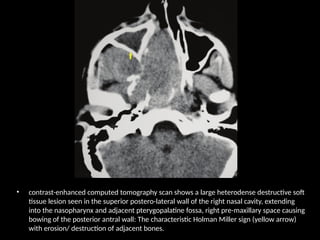 • contrast-enhanced computed tomography scan shows a large heterodense destructive soft
tissue lesion seen in the superior postero-lateral wall of the right nasal cavity, extending
into the nasopharynx and adjacent pterygopalatine fossa, right pre-maxillary space causing
bowing of the posterior antral wall: The characteristic Holman Miller sign (yellow arrow)
with erosion/ destruction of adjacent bones.
 