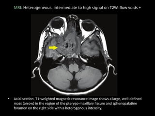 MRI: Heterogeneous, intermediate to high signal on T2W, flow voids +
• Axial section, T1-weighted magnetic resonance image shows a large, well-defined
mass (arrow) in the region of the pterygo-maxillary fissure and sphenopalatine
foramen on the right side with a heterogenous intensity.
 