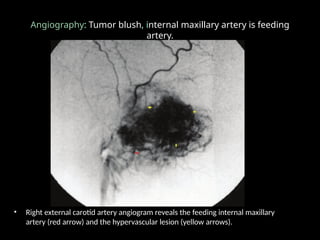 Angiography: Tumor blush, internal maxillary artery is feeding
artery.
• Right external carotid artery angiogram reveals the feeding internal maxillary
artery (red arrow) and the hypervascular lesion (yellow arrows).
 