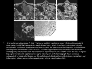 • Sinonasal angiomatous polyp. A, Axial T1WI shows a slightly hypointense lesion in left maxillary sinus and
nasal cavity. B, Axial T2WI demonstrates a well-defined lesion, which shows hyperintense signal intensity
centrally with a peripheral hypointense rim (white arrows). The hyperintense signal intensity in the ipsilateral
maxillary sinus indicates obstructive sinusitis. C, Axial fat-suppressed contrast-enhanced T1WI shows the
marked patchy enhancement with the nonenhanced hypointense rim. D, Axial DWI shows the mass of slightly
high signal intensity with a peripheral low-signal-intensity rim. E, Photomicrograph shows numerous
extravasated red blood cells, fibrosis, and thin-walled vessels. Scattered hemosiderin-laden macrophages and
inflammatory cells are also seen (hematoxylin-eosin, original magnification ×200).
 