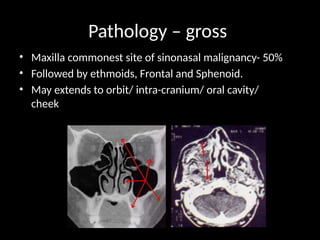 Pathology – gross
• Maxilla commonest site of sinonasal malignancy- 50%
• Followed by ethmoids, Frontal and Sphenoid.
• May extends to orbit/ intra-cranium/ oral cavity/
cheek
 