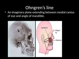 Ohngren’s line
• An imaginary plane extending between medial cantus
of eye and angle of mandible.
 