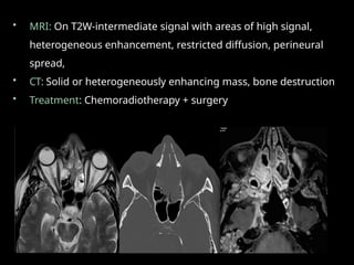 • MRI: On T2W-intermediate signal with areas of high signal,
heterogeneous enhancement, restricted diffusion, perineural
spread,
• CT: Solid or heterogeneously enhancing mass, bone destruction
• Treatment: Chemoradiotherapy + surgery
 