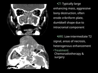 •CT: Typically large
enhancing mass, aggressive
bony destruction, often
erode cribriform plate,
dumbbell shape due to
intracranial component
•MRI: Low-intermediate T2
signal, areas of necrosis,
heterogenous enhancement
•Treatment:
Chemoradiotherapy &
surgery
 