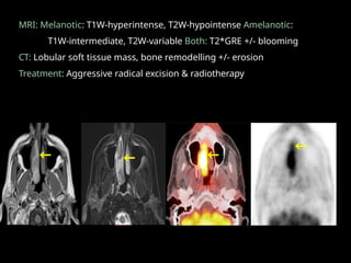 MRI: Melanotic: T1W-hyperintense, T2W-hypointense Amelanotic:
T1W-intermediate, T2W-variable Both: T2*GRE +/- blooming
CT: Lobular soft tissue mass, bone remodelling +/- erosion
Treatment: Aggressive radical excision & radiotherapy
 