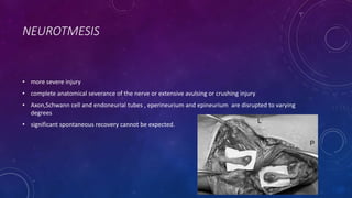 NEUROTMESIS
• more severe injury
• complete anatomical severance of the nerve or extensive avulsing or crushing injury
• Axon,Schwann cell and endoneurial tubes , eperineurium and epineurium are disrupted to varying
degrees
• significant spontaneous recovery cannot be expected.
 