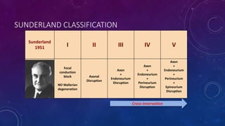 SUNDERLAND CLASSIFICATION
Sunderland
1951 I II III IV V
Focal
conduction
block
NO Wallerian
degeneration
Axonal
Disruption
Axon
+
Endoneurium
Disruption
Axon
+
Endoneurium
+
Perineurium
Disruption
Axon
+
Endoneurium
+
Perineurium
+
Epineurium
Disruption
Cross-innervation
 