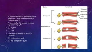 • In this classification, peripheral nerve
injuries are arranged in ascending
order of severity
• Anatomically, the various degrees
represent injury to
• (1) myelin,
• (2) axon,
• (3) the endoneurial tube and its
contents,
• (4) perineurium, and
• (5) the entire nerve trunk
 