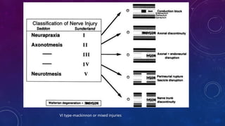 VI type-mackinnon or mixed injuries
 