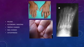 • RELEXES
• AUTONOMIC- SWEATING
• TROPHIC CHANGES
• NAIL CHANGES
• OSTEOPOROSIS
 