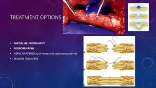TREATMENT OPTIONS
• PARTIAL NEURORRHAPHY
• NEURORRHAPHY
• NERVE GRAFTING(sural nerve and saphaneous nerve)
• TENDON TRANSFERS
 