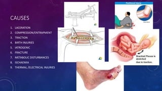 CAUSES
1. LACERATION
2. COMPRESSION/ENTRAPMENT
3. TRACTION
4. BIRTH INJURIES
5. IATROGENIC
6. FRACTURE
7. METABOLIC DISTURBANCES
8. ISCHAEMIA
9. THERMAL /ELECTRICAL INJURIES
 