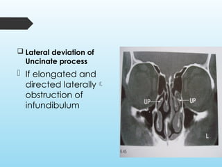 Paranasal Sinuses: Radiological Anatomy and Variants | PPTX