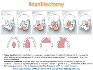Brown Defect Classification Paranasal sinus diseases and their management | PPTX