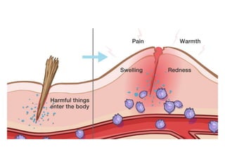Comprehensive Overview of Acute Inflammation: Causes, Pathophysiology ...