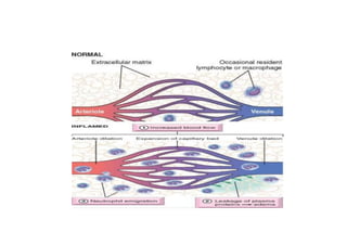 Comprehensive Overview of Acute Inflammation: Causes, Pathophysiology ...