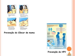 Prevenção do Câncer de mama Prevenção do HPV 