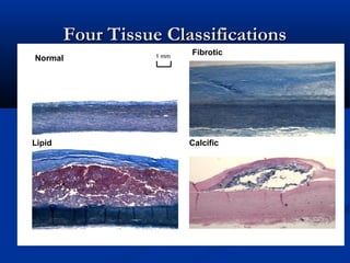 Four Tissue ClassificationsFour Tissue Classifications
1 mmNormal
Fibrotic
Lipid Calcific
 