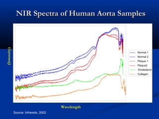 NIR Spectra of Human Aorta SamplesNIR Spectra of Human Aorta Samples
Source: Infraredx, 2002
Normal 1
Normal 2
Plaque 1
Plaque2
Cholesterol
Collagen
Wavelength
(Intensity)
 