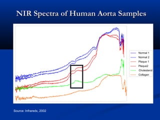 NIR Spectra of Human Aorta SamplesNIR Spectra of Human Aorta Samples
Source: Infraredx, 2002
Normal 1
Normal 2
Plaque 1
Plaque2
Cholesterol
Collagen
 