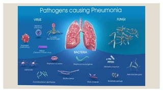 Pnumonia and its management | PPTX