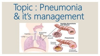 Pnumonia and its management | PPTX
