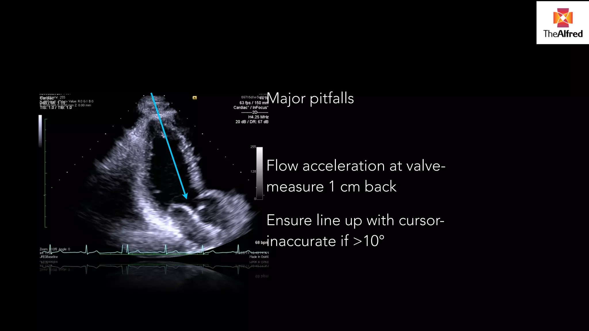 Major pitfalls 
! 
Flow acceleration at valve-measure 
1 cm back 
Ensure line up with cursor-inaccurate 
if >10° 
 