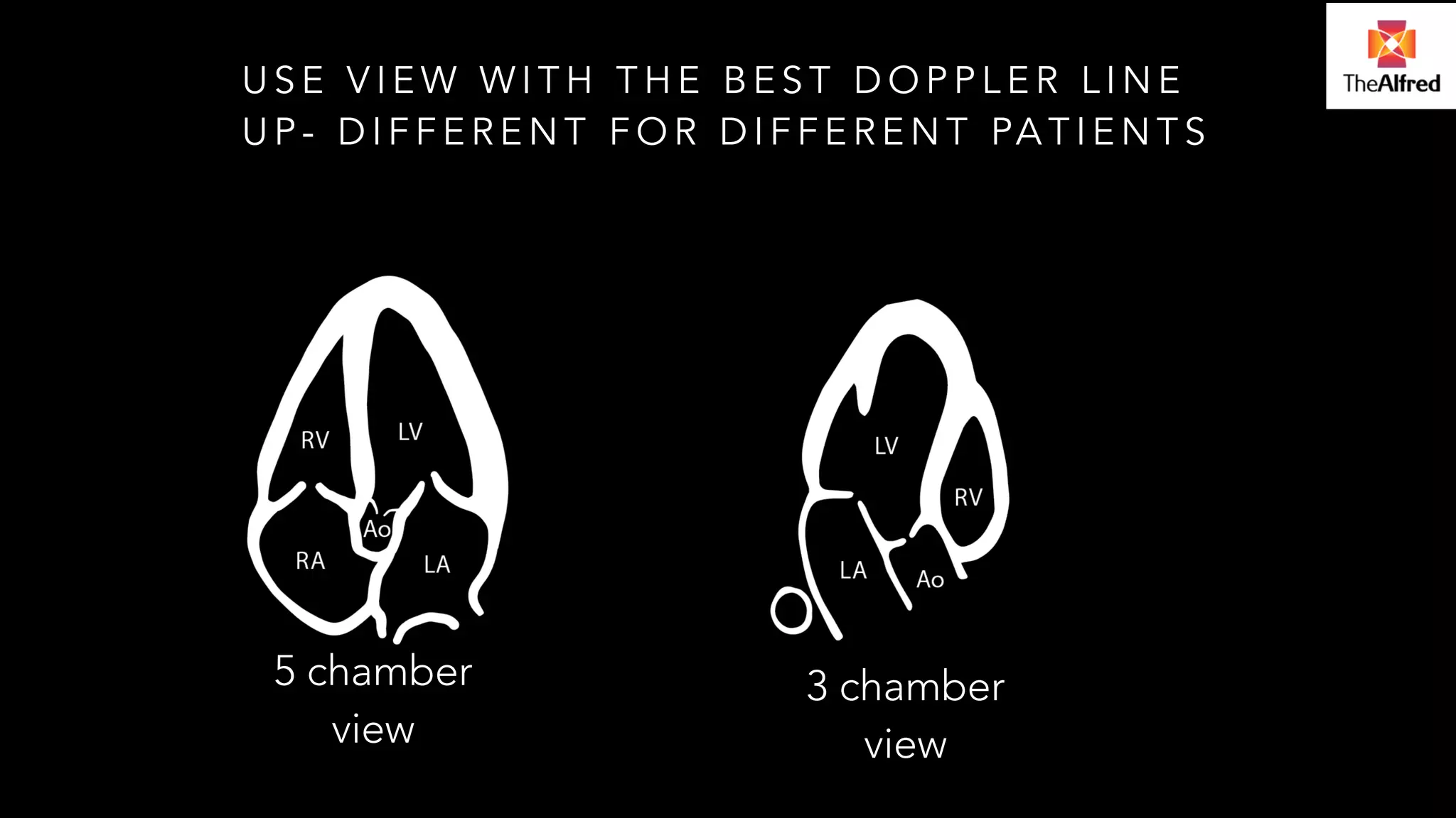 USE VIEW WITH THE BEST DOPPLER LINE 
UP- DIFFERENT FOR DIFFERENT PATIENTS 
5 chamber 
view 
3 chamber 
view 
 