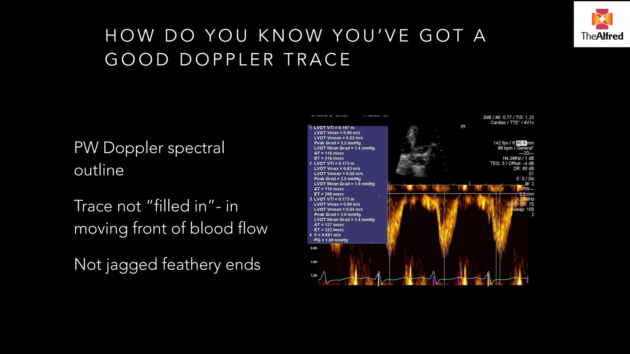 HOW DO YOU KNOW YOU’VE GOT A 
GOOD DOPPLER TRACE 
PW Doppler spectral 
outline 
Trace not “filled in”- in 
moving front of blood flow 
Not jagged feathery ends 
 