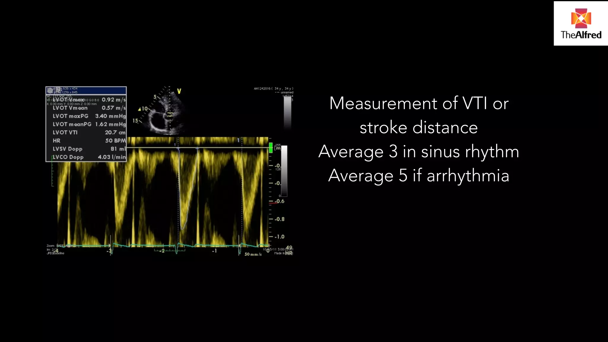 Measurement of VTI or 
stroke distance 
Average 3 in sinus rhythm 
Average 5 if arrhythmia 
 