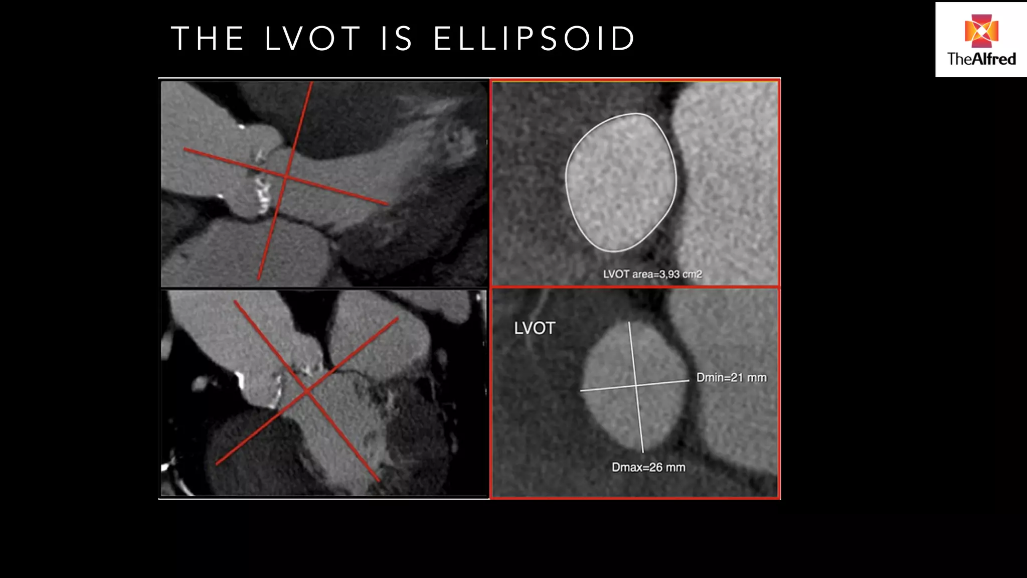 THE LVOT IS ELLIPSOID 
! ! 
! ! 
 
