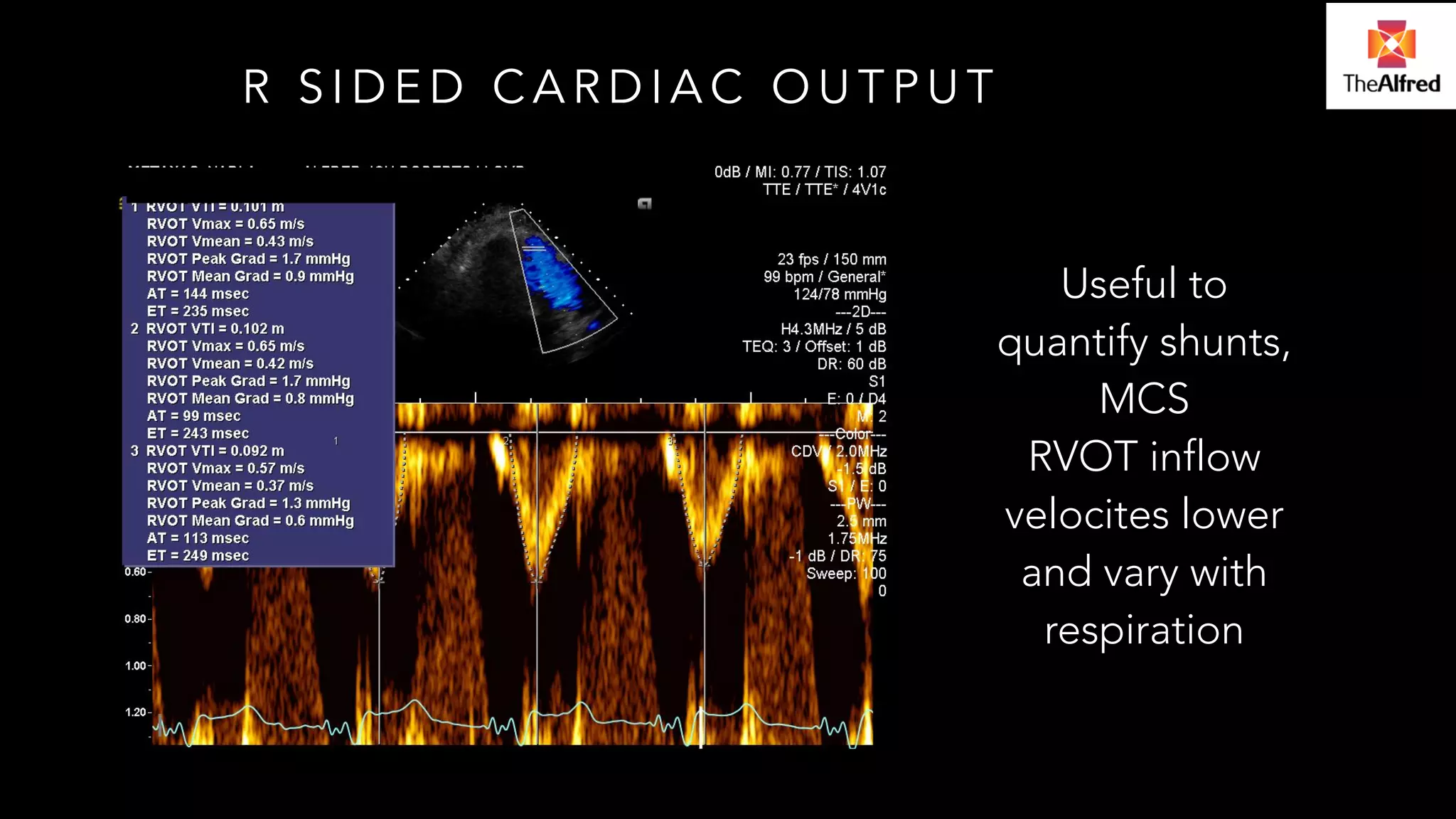 R SIDED CARDIAC OUTPUT 
Useful to 
quantify shunts, 
MCS 
RVOT inflow 
velocites lower 
and vary with 
respiration 
 