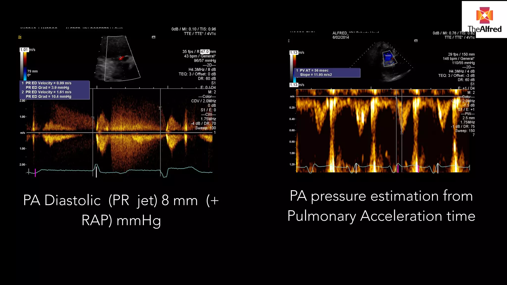 PA Diastolic (PR jet) 8 mm (+ 
RAP) mmHg 
PA pressure estimation from 
Pulmonary Acceleration time 
 