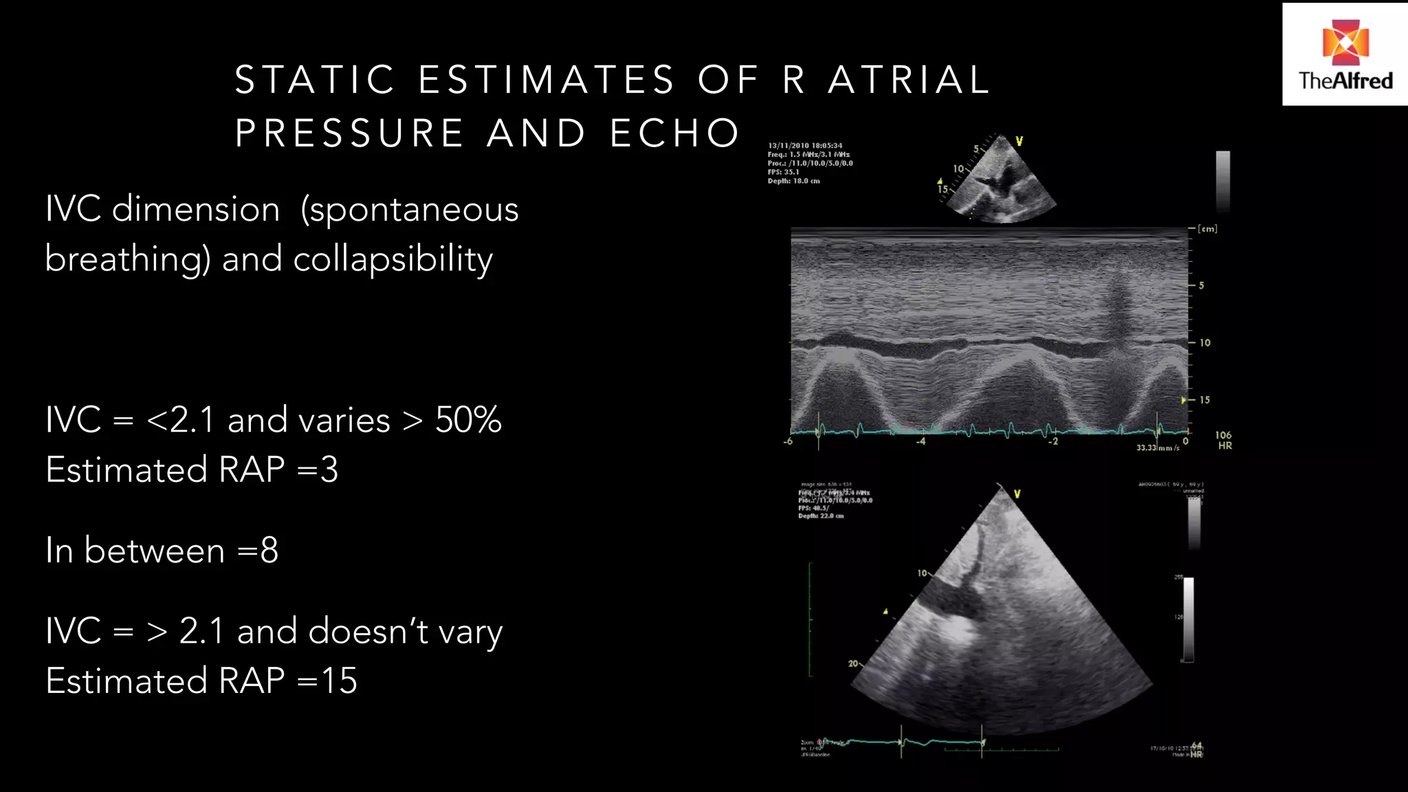 STATIC ESTIMATES OF R ATRIAL 
PRESSURE AND ECHO 
IVC dimension (spontaneous 
breathing) and collapsibility 
! 
IVC = <2.1 and varies > 50% 
Estimated RAP =3 
In between =8 
IVC = > 2.1 and doesn’t vary 
Estimated RAP =15 
 