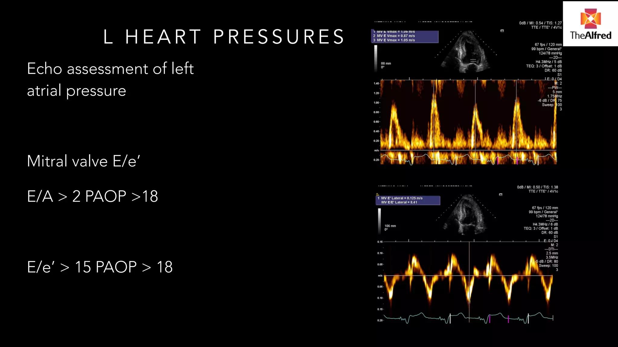 L HEART PRESSURES 
Echo assessment of left 
atrial pressure 
! 
Mitral valve E/e’ 
E/A > 2 PAOP >18 
! 
E/e’ > 15 PAOP > 18 
 
