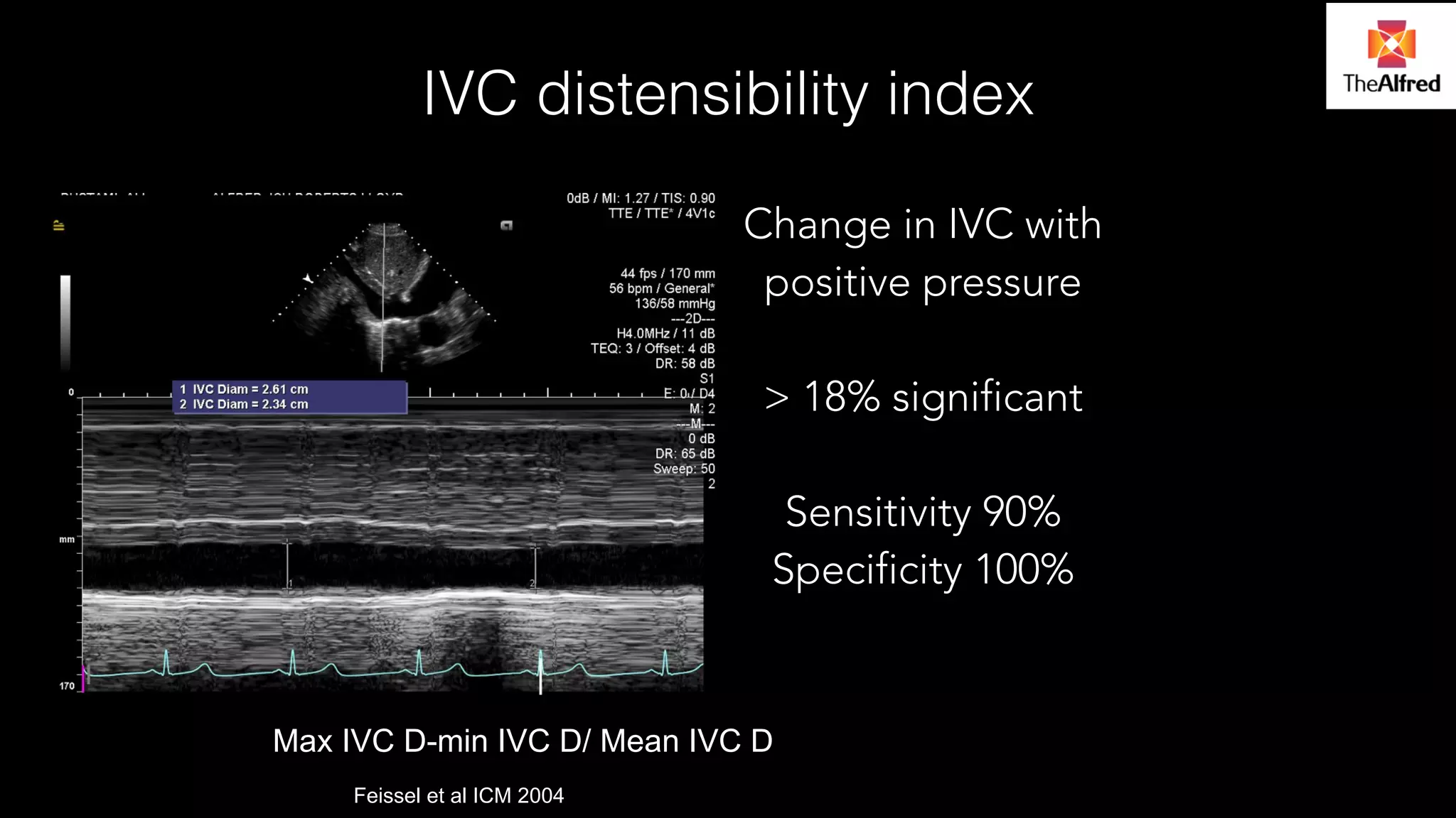 IVC distensibility index 
Change in IVC with 
positive pressure 
! 
> 18% significant 
! 
Sensitivity 90% 
Specificity 100% 
– Cut off of 18% 
–Max IVC D-min IVC D/ Mean IVC D 
Max IVC diameter-min IVC diameter/ mean IVC 
diameterFeissel et al ICM 2004 
 