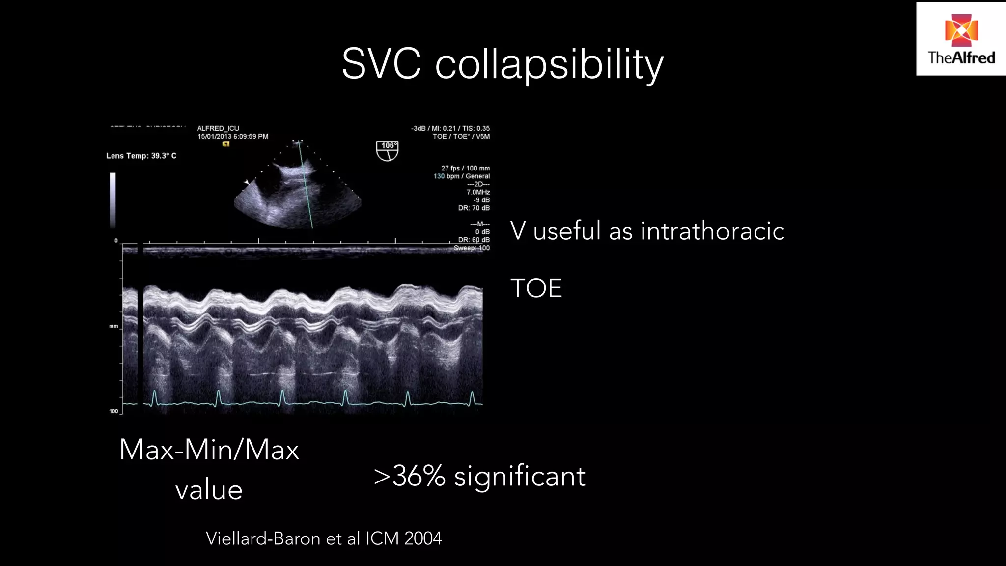 SVC collapsibility 
V useful as intrathoracic 
TOE 
>36% significant 
Max-Min/Max 
value 
Viellard-Baron et al ICM 2004 
 