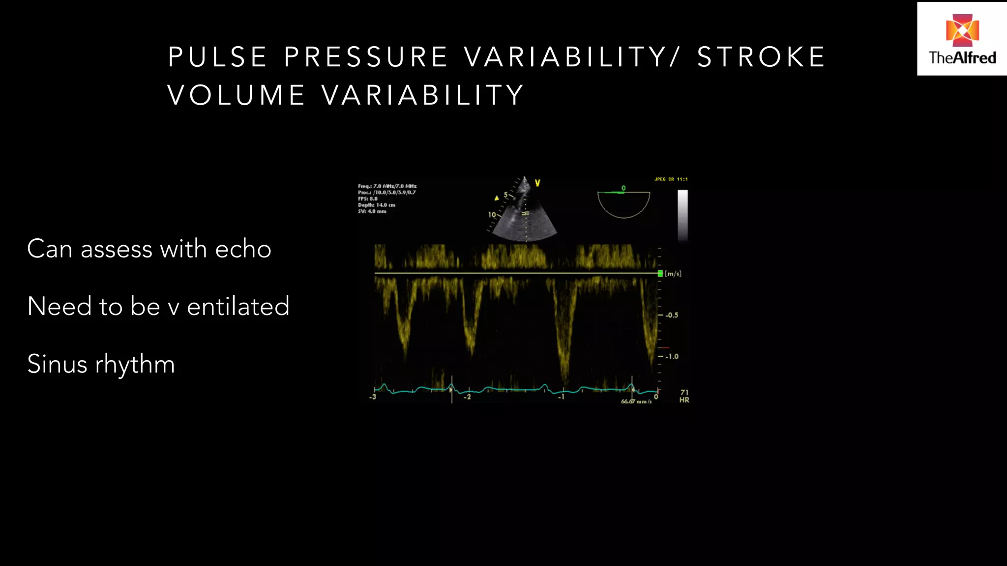 PULSE PRESSURE VARIABILITY/ STROKE 
VOLUME VARIABILITY 
Can assess with echo 
Need to be v entilated 
Sinus rhythm 
 