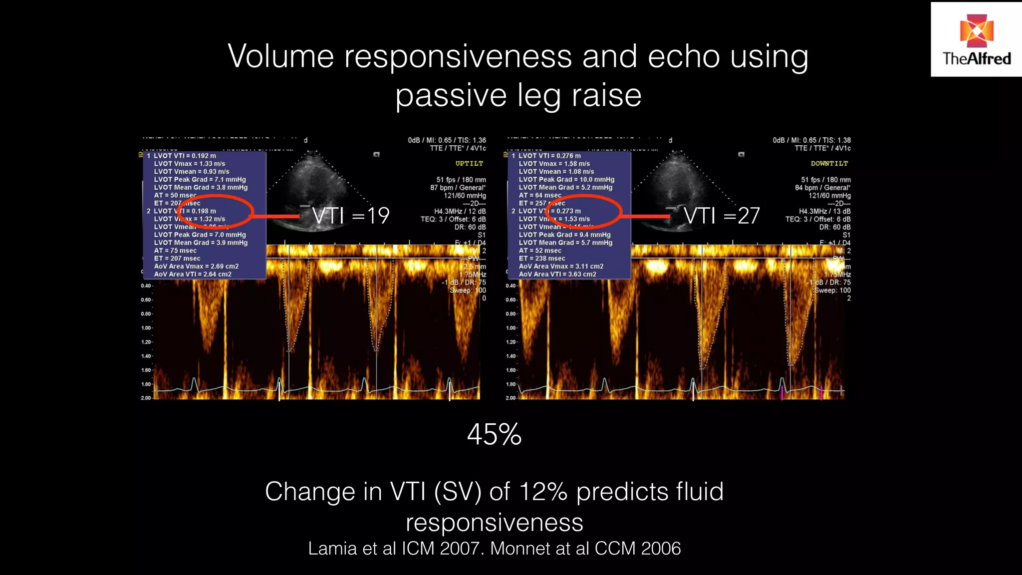Volume responsiveness and echo using 
passive leg raise 
VTI =19 VTI =27 
45% 
Change in VTI (SV) of 12% predicts fluid 
responsiveness 
Lamia et al ICM 2007. Monnet at al CCM 2006 
 